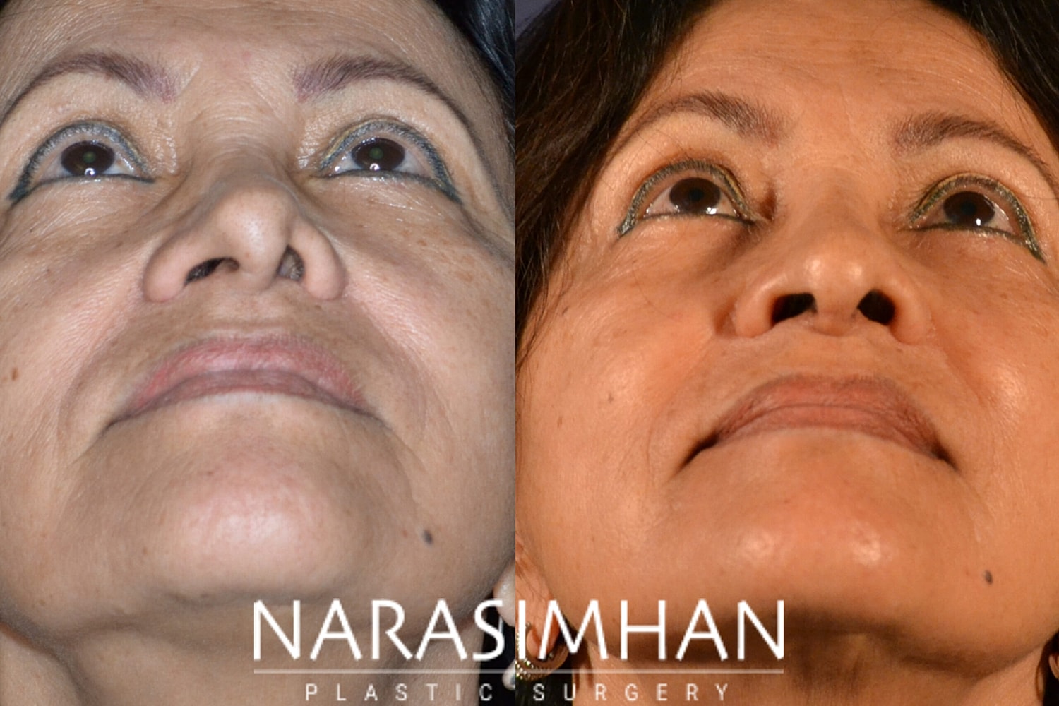 Facial Sculpting Before & After