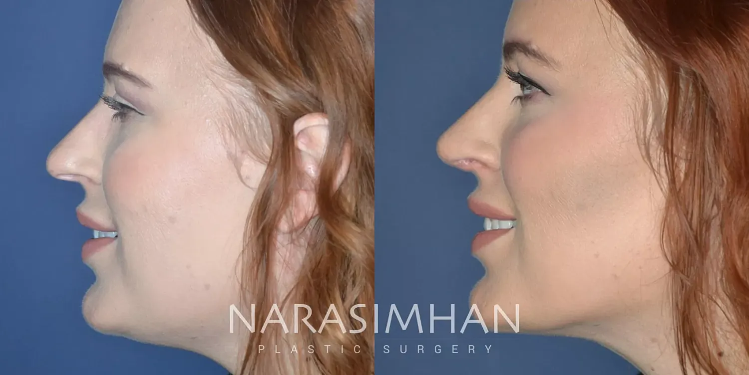 Facial Sculpting Before & After