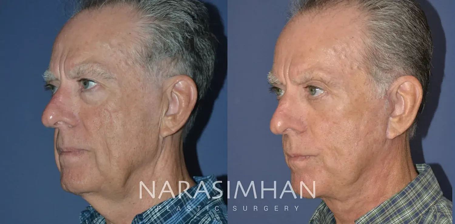 Facial Sculpting Before & After