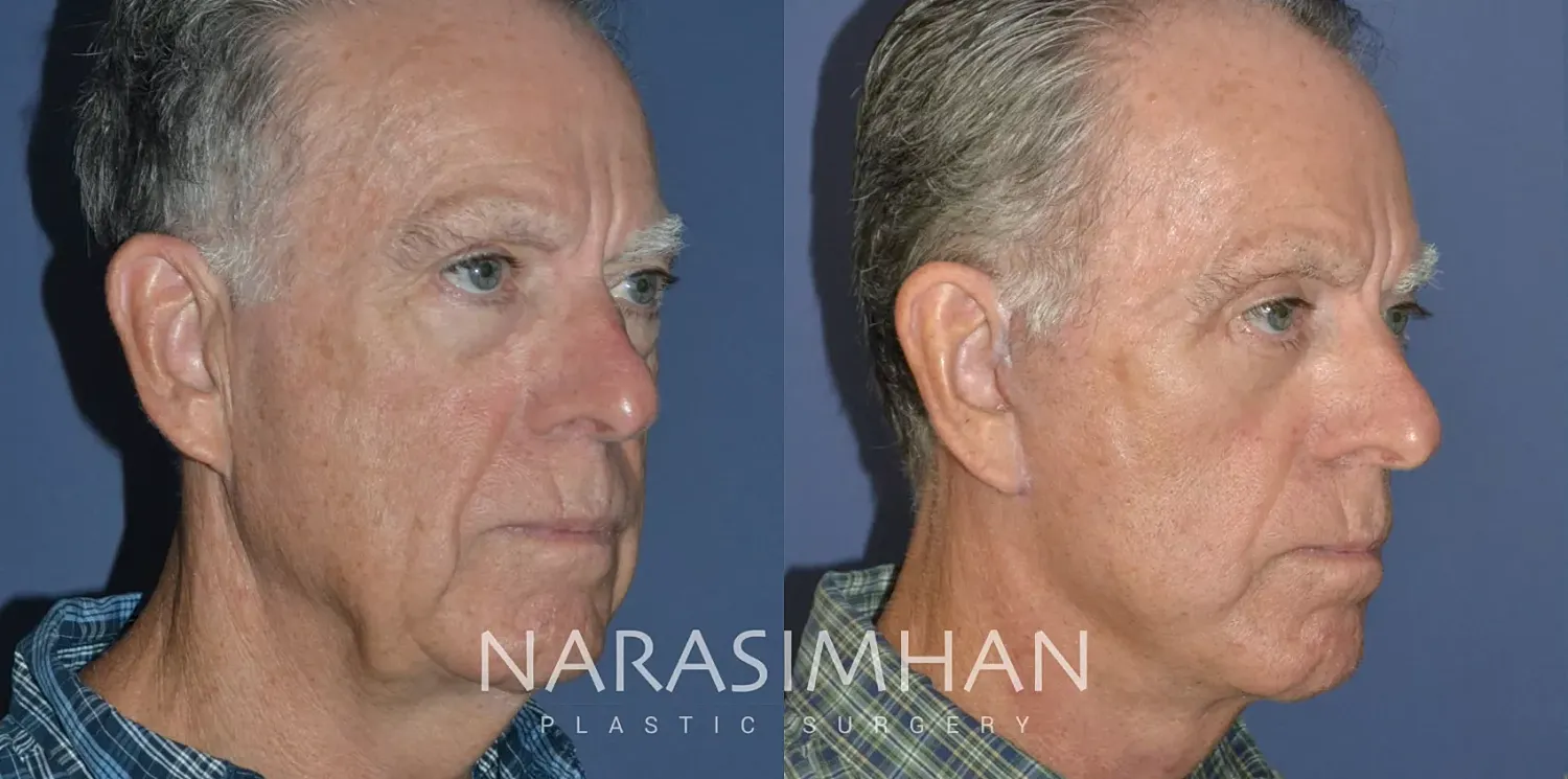 Facial Sculpting Before & After