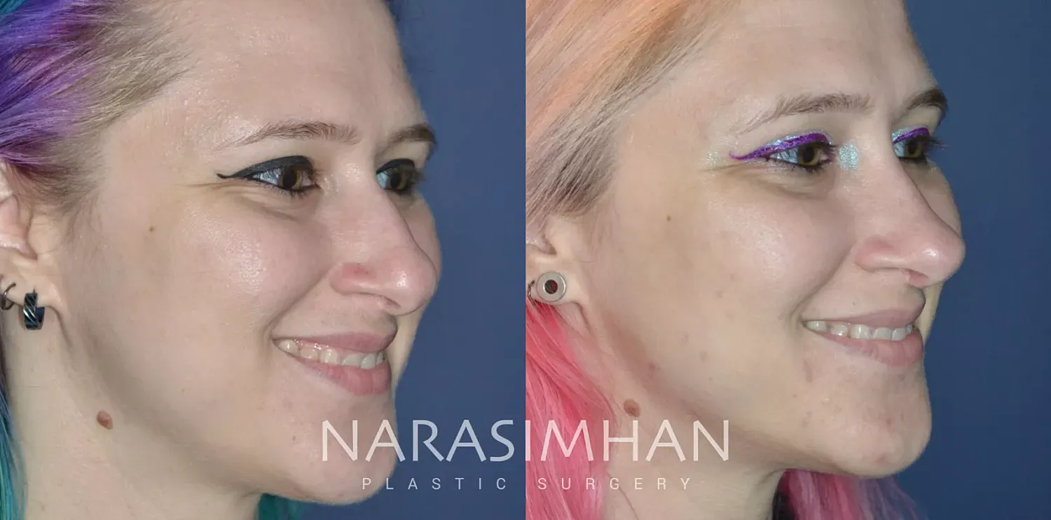 Facial Sculpting Before & After