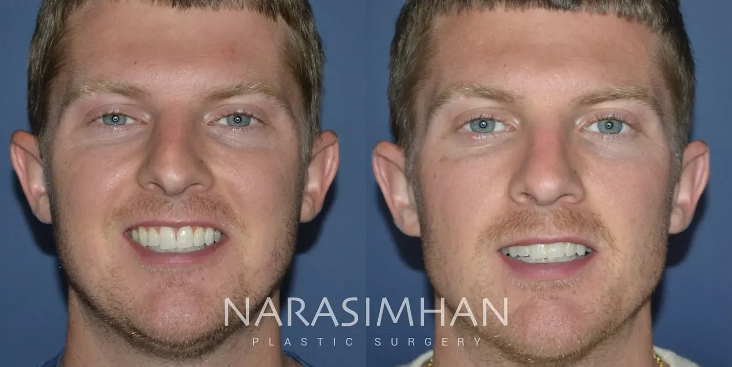 Facial Sculpting Before & After