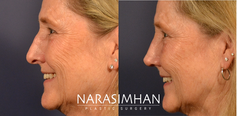 Facial Sculpting Before & After