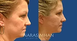 Facial Sculpting Before & After