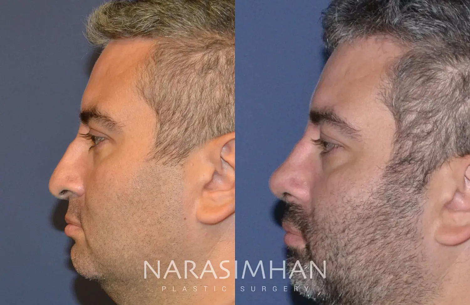 Facial Sculpting Before & After