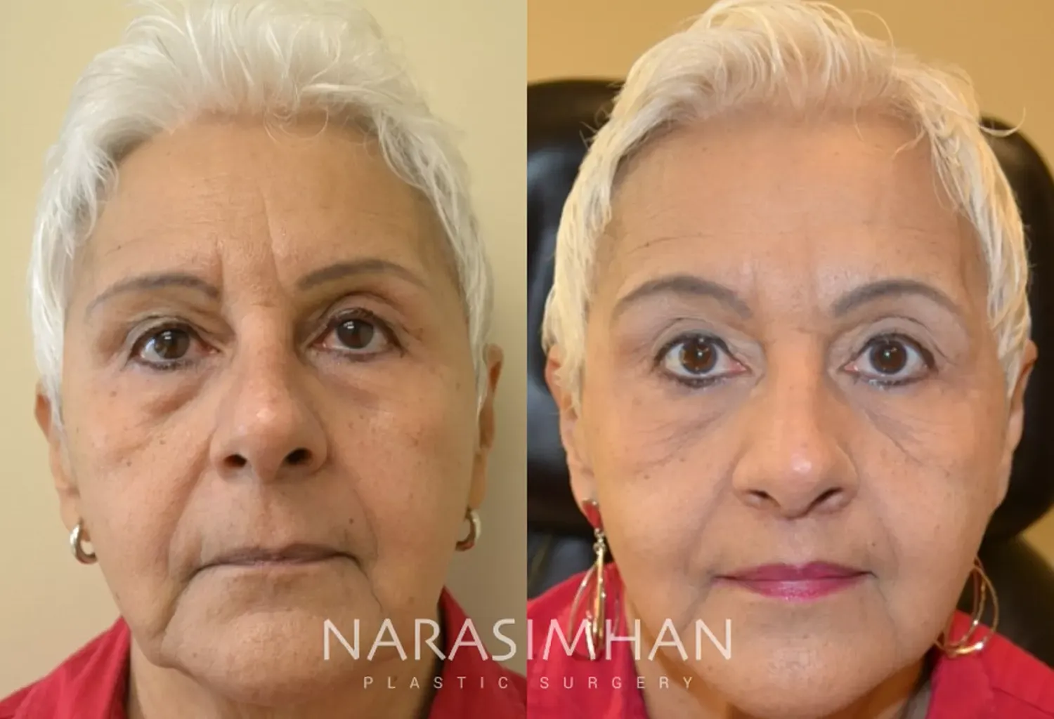Facial Sculpting Before & After