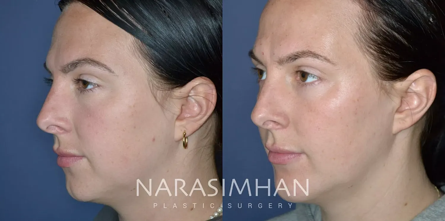 Facial Sculpting Before & After