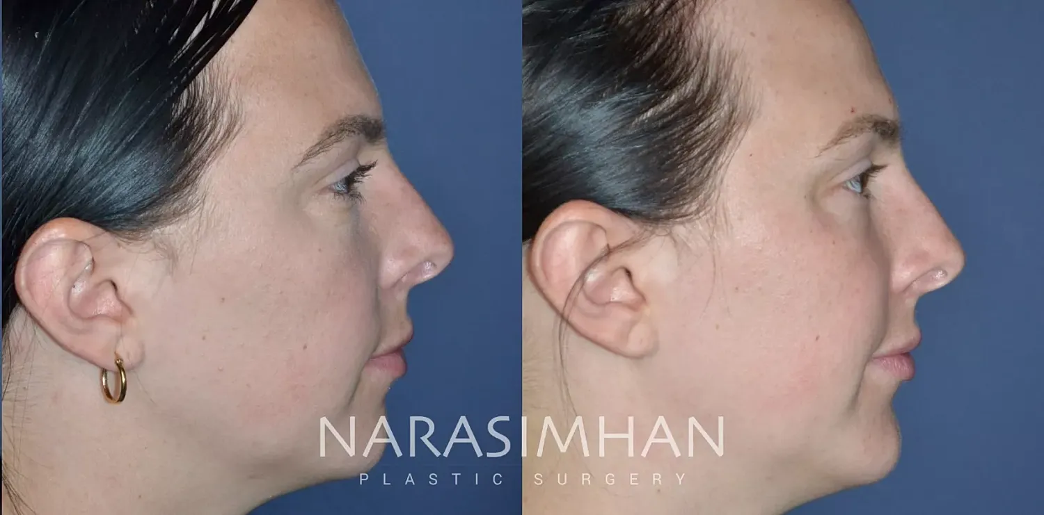 Facial Sculpting Before & After