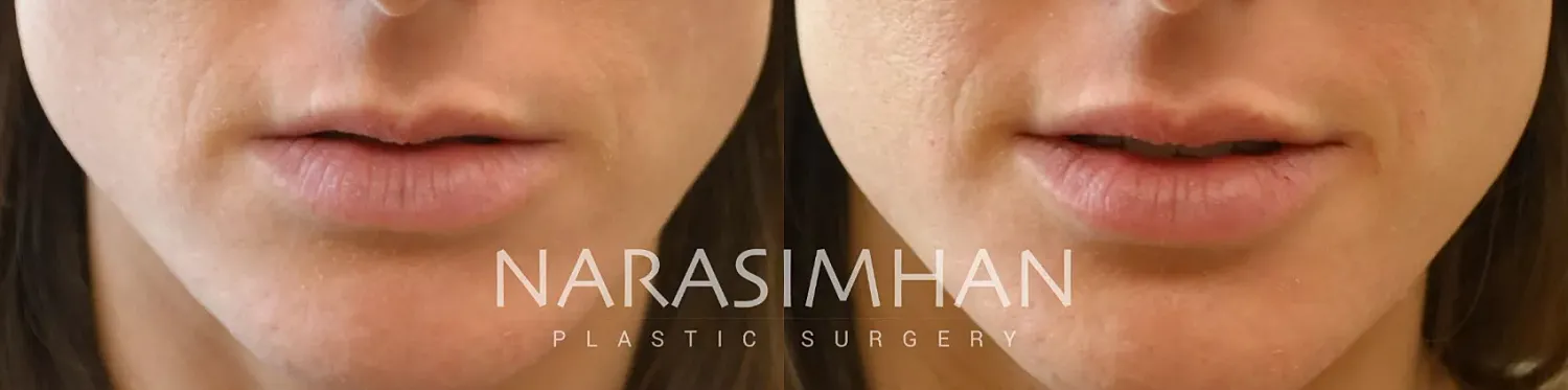 Facial Sculpting Before & After