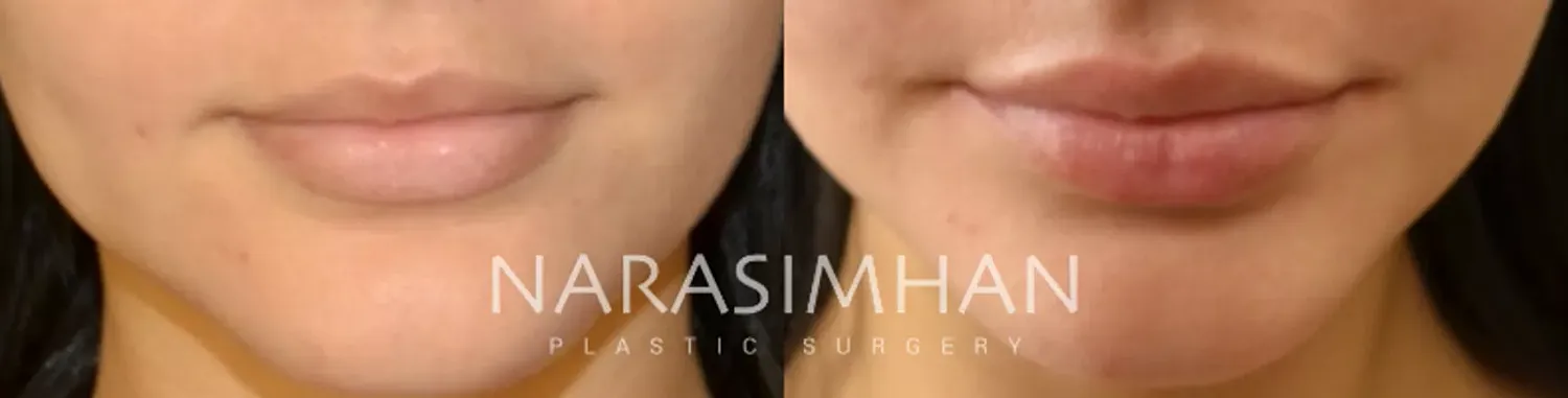 Facial Sculpting Before & After