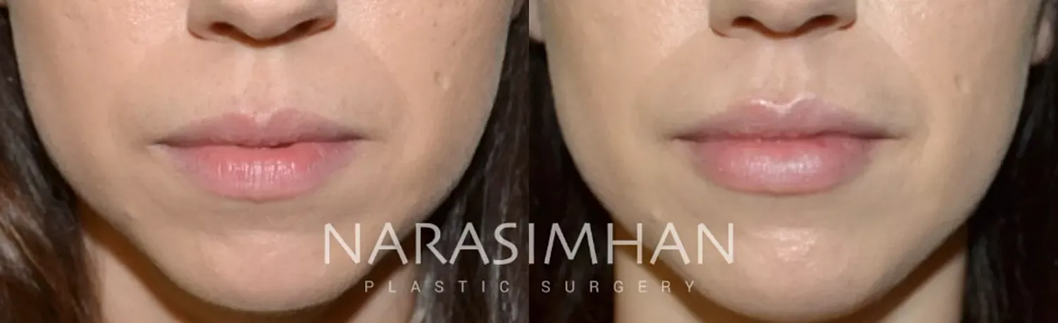Facial Sculpting Before & After