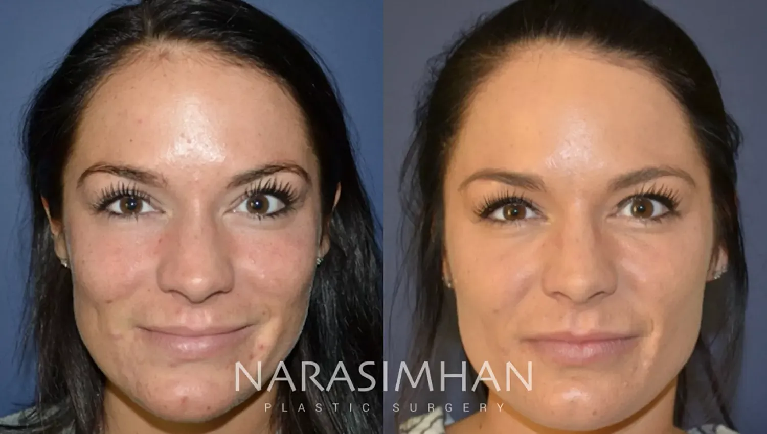 Facial Sculpting Before & After