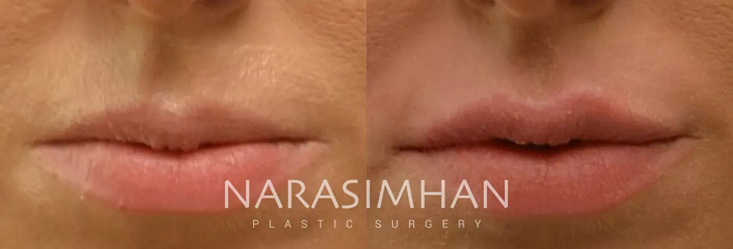 Facial Sculpting Before & After