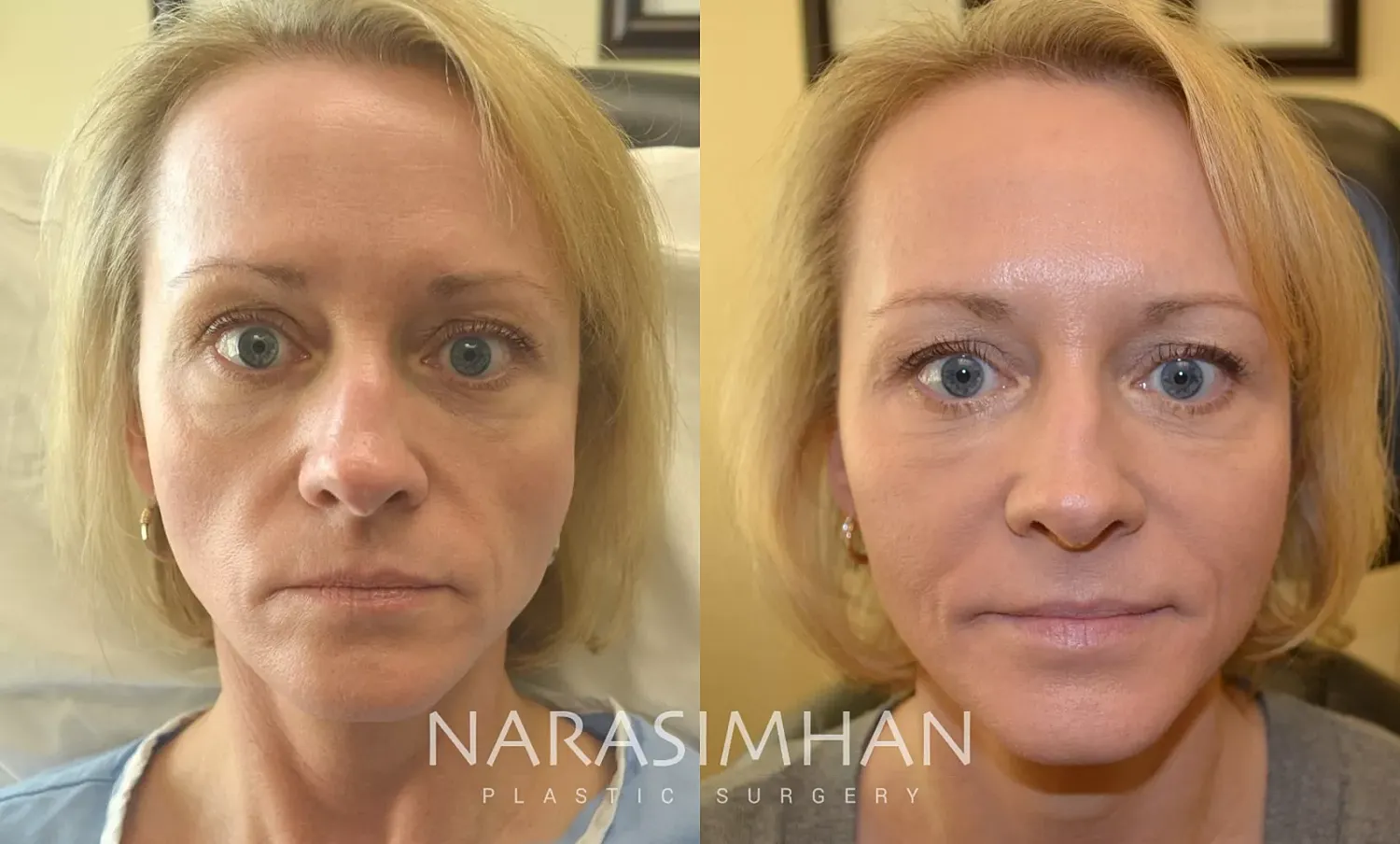 Facial Sculpting Before & After