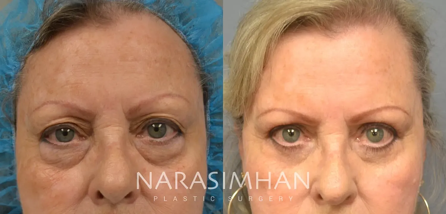 Facial Sculpting Before & After