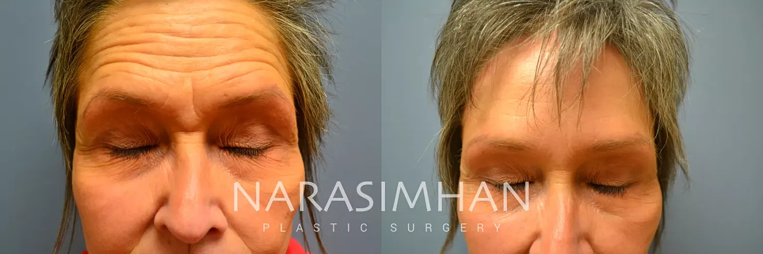 Facial Sculpting Before & After