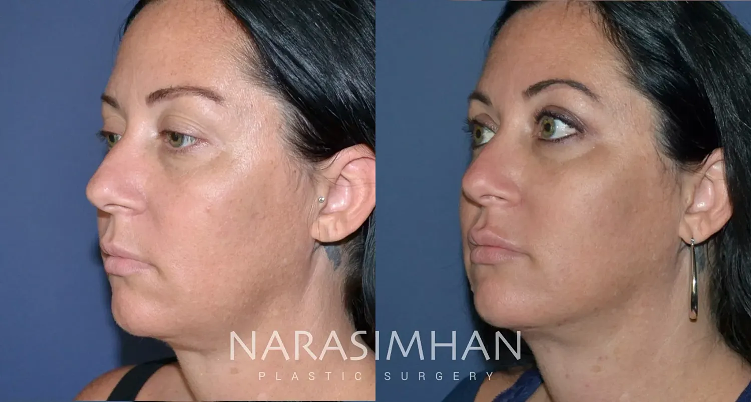 Facial Sculpting Before & After