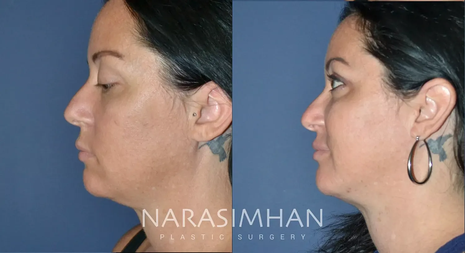 Facial Sculpting Before & After