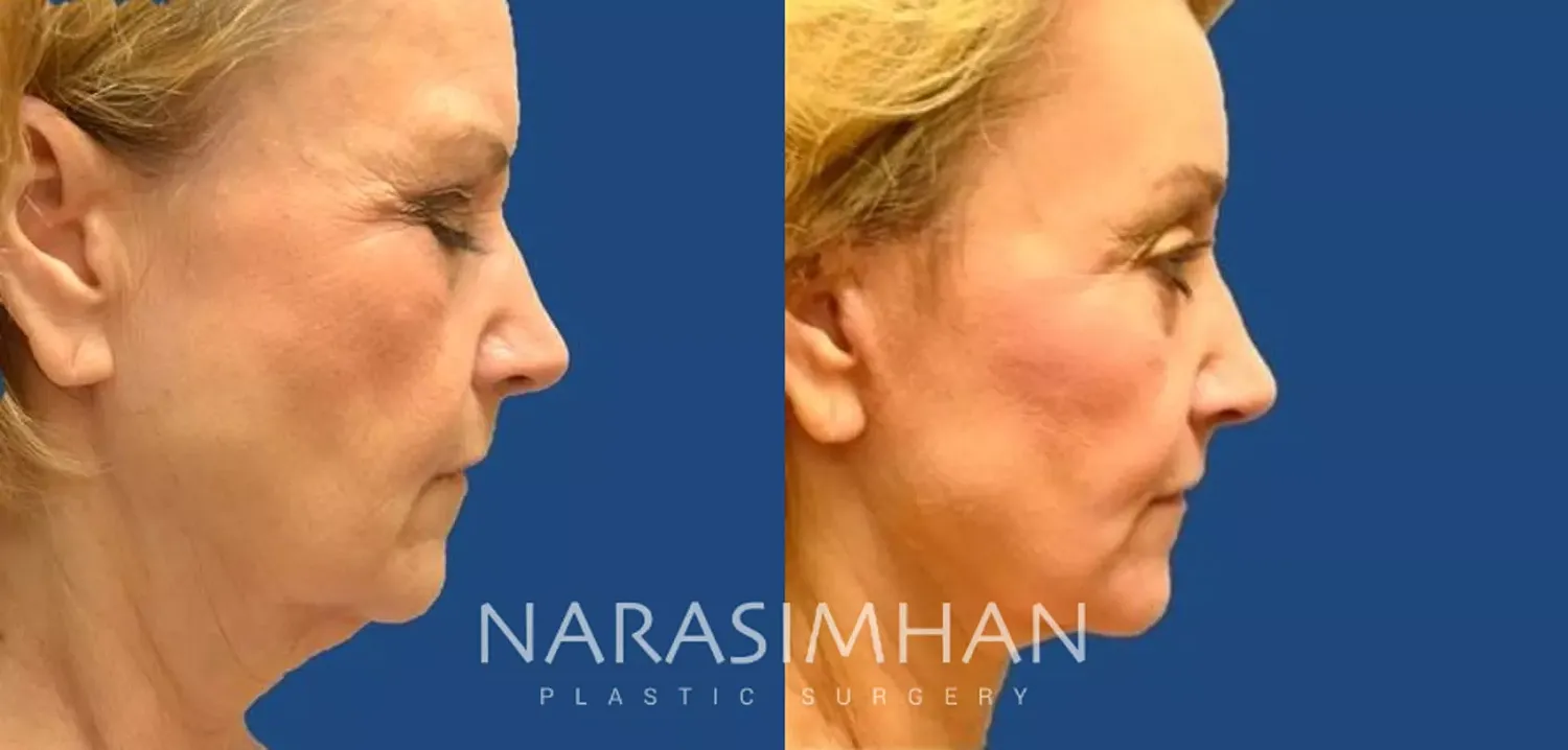 Facial Sculpting Before & After