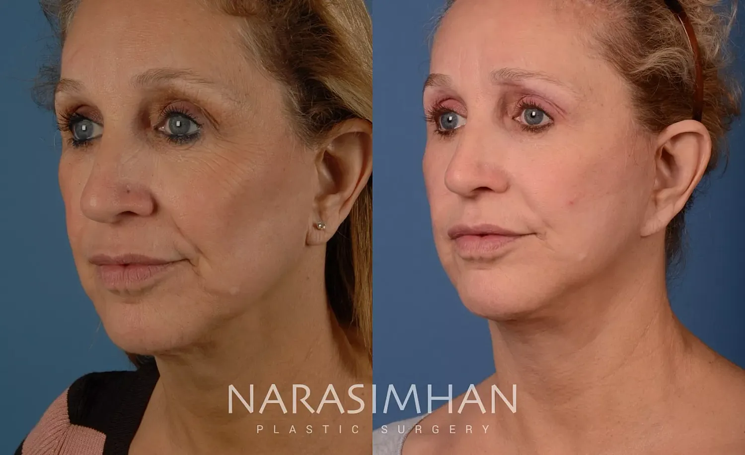 Facial Sculpting Before & After