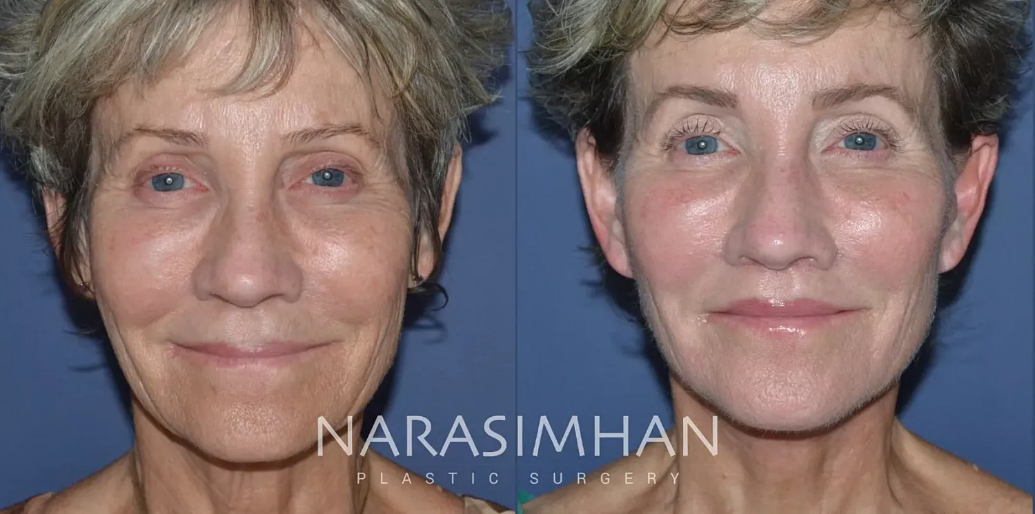 Facial Sculpting Before & After