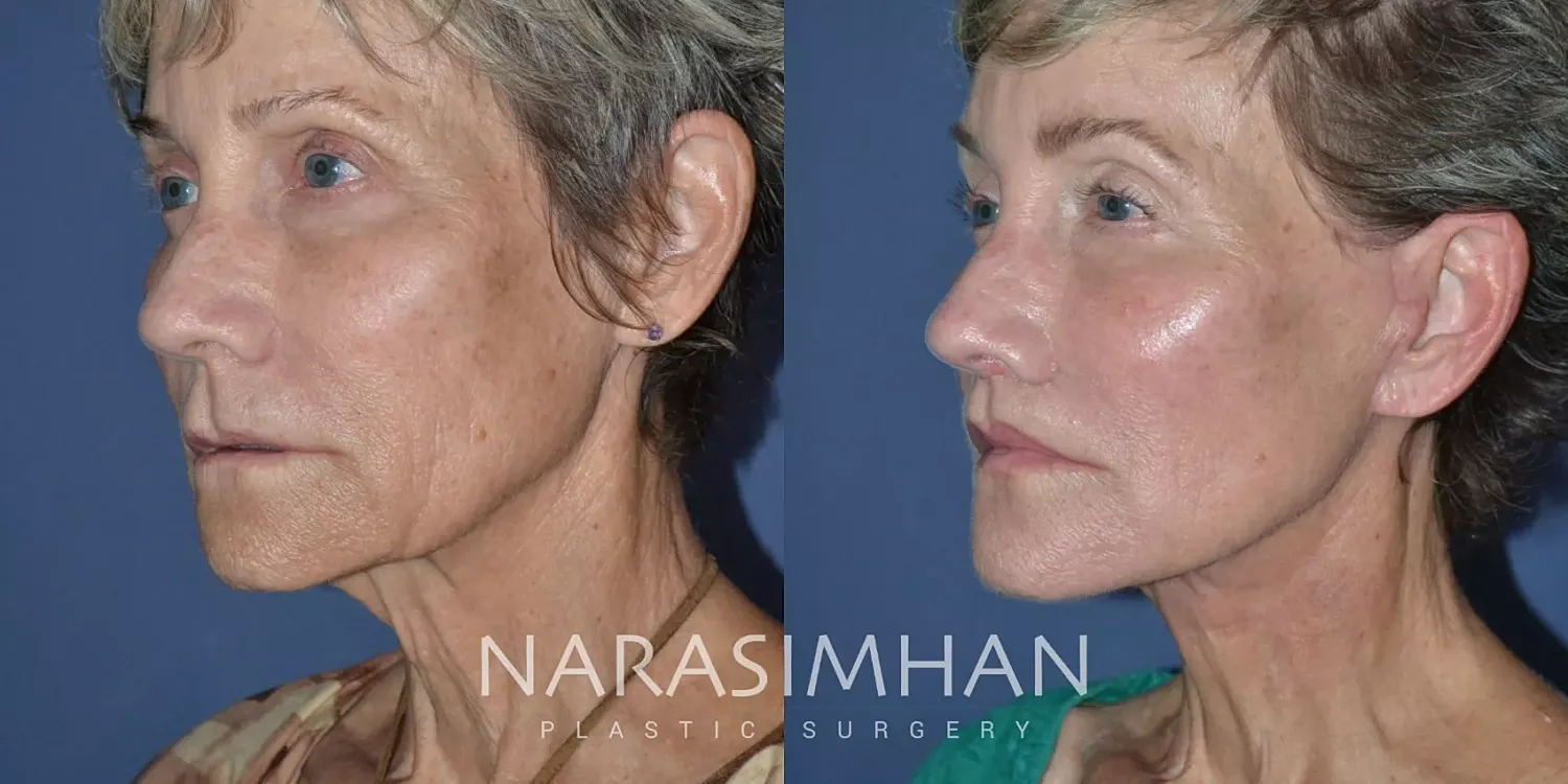 Facial Sculpting Before & After