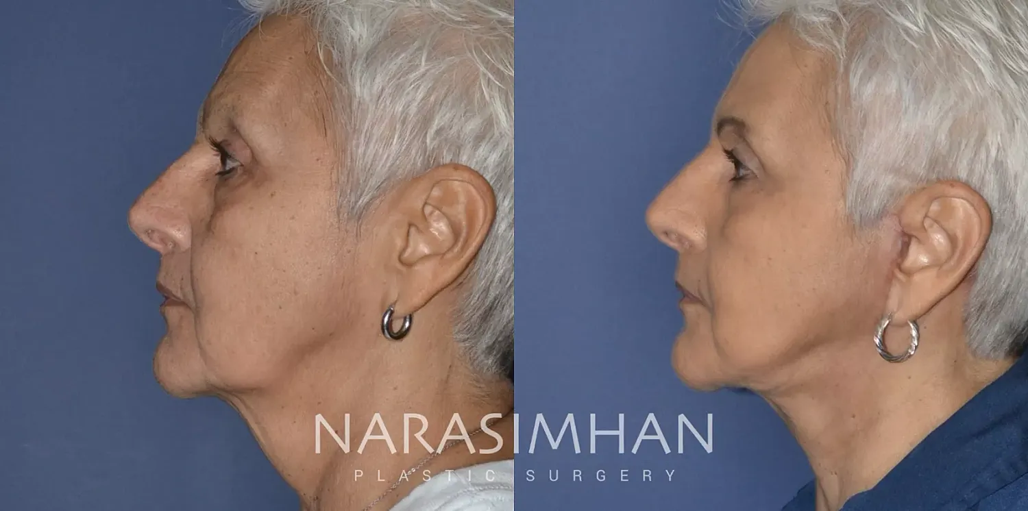 Facial Sculpting Before & After