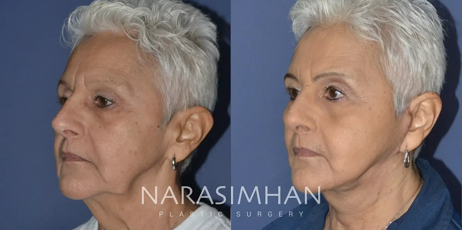 Facial Sculpting Before & After