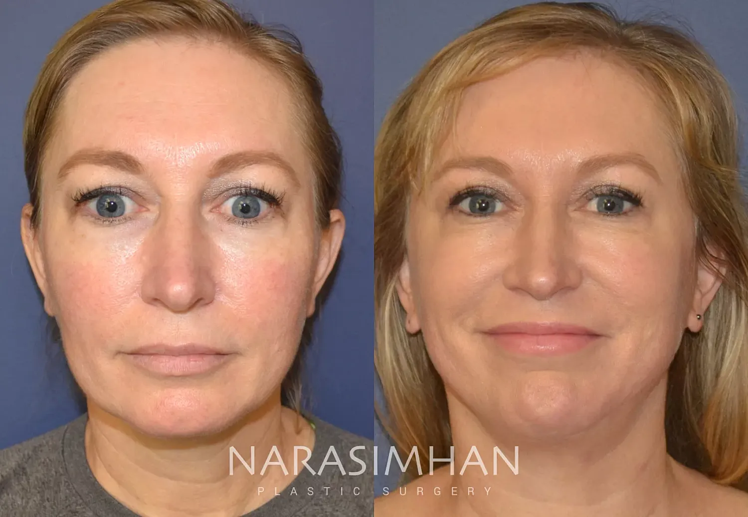 Facial Sculpting Before & After