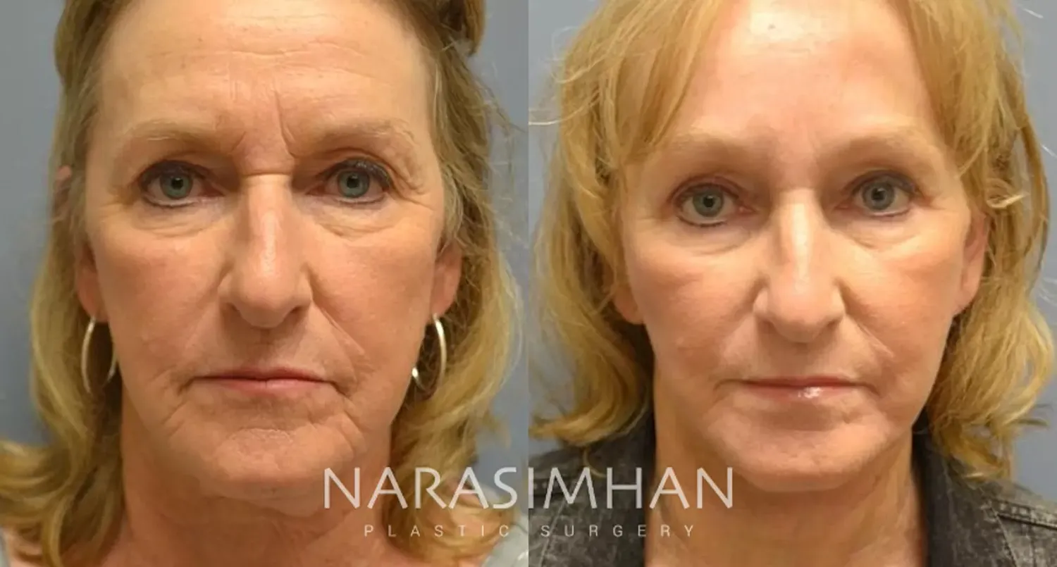 Facial Sculpting Before & After