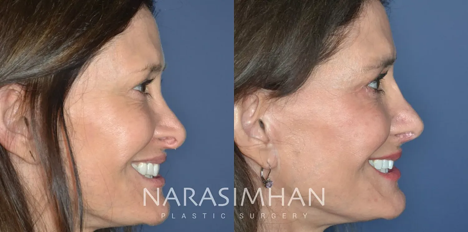 Facial Sculpting Before & After