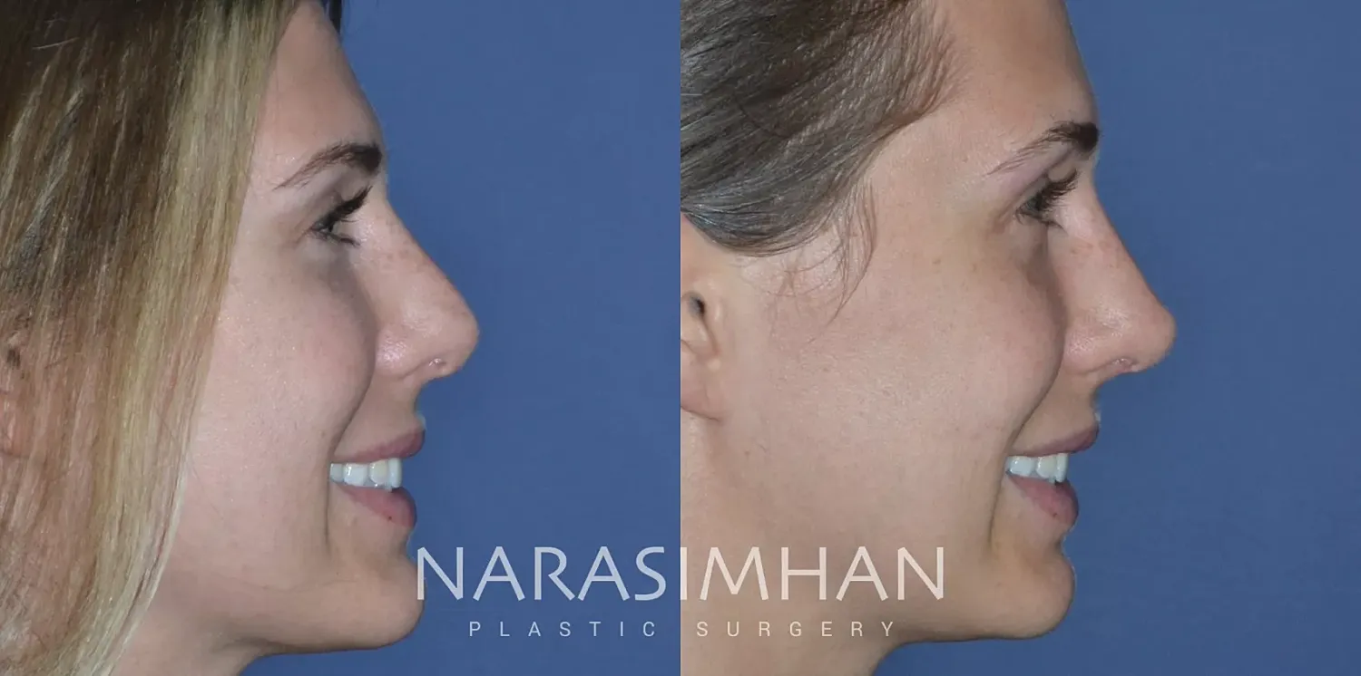 Facial Sculpting Before & After
