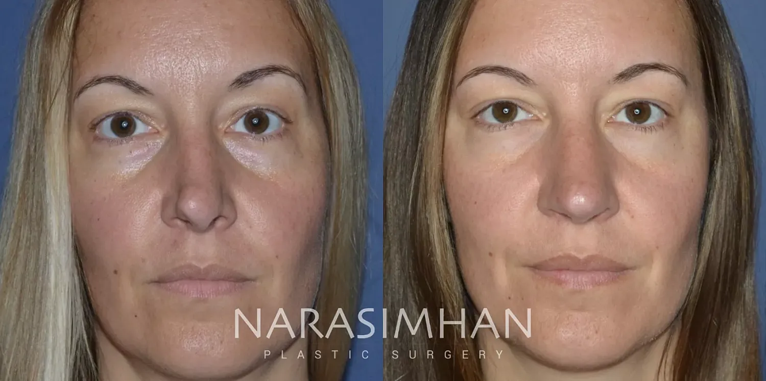 Facial Sculpting Before & After
