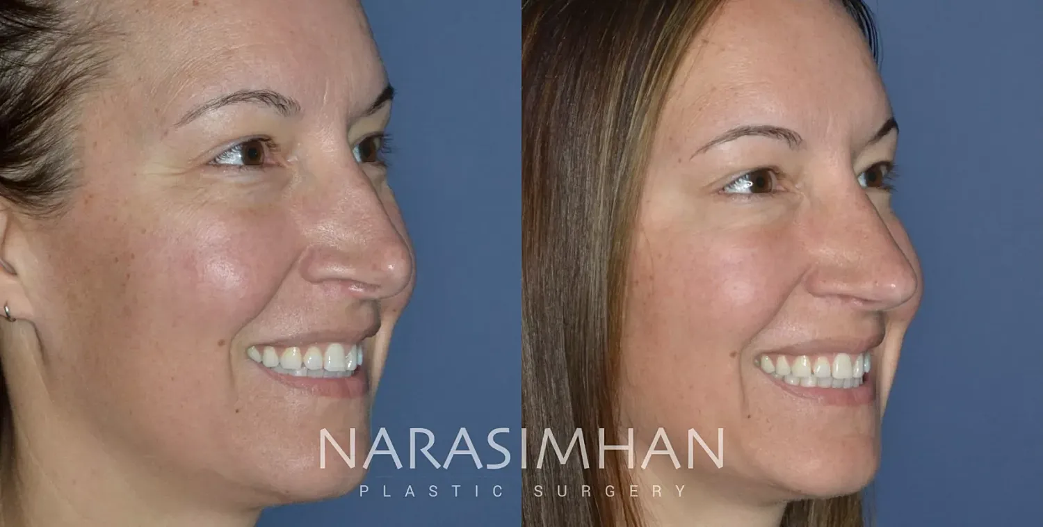 Facial Sculpting Before & After