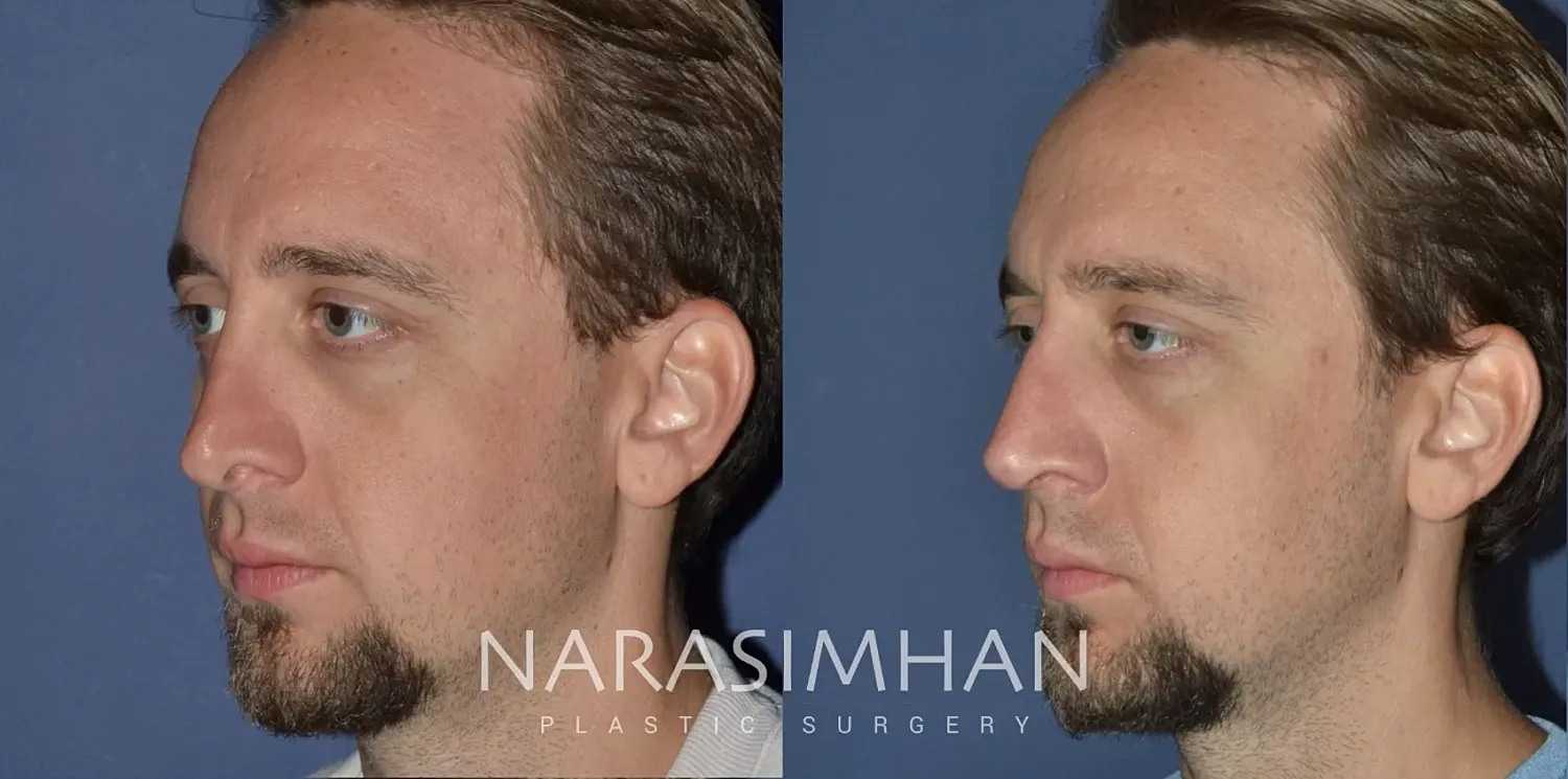 Facial Sculpting Before & After
