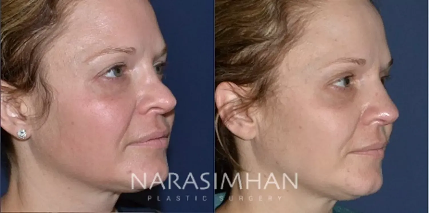 Facial Sculpting Before & After