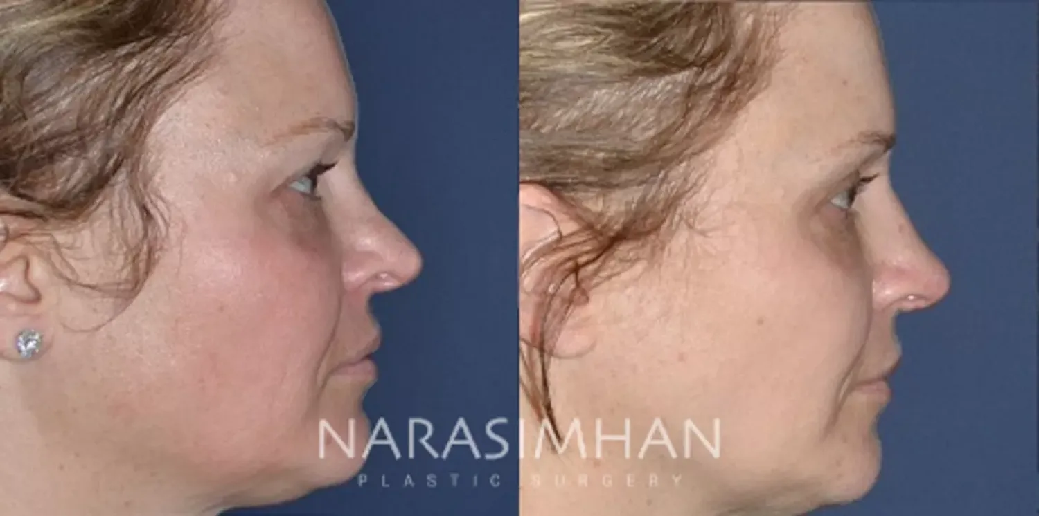 Facial Sculpting Before & After