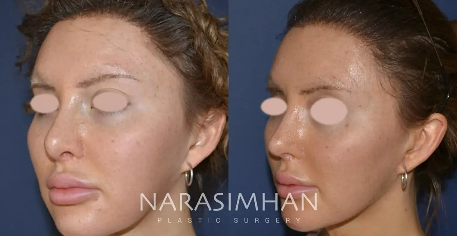 Facial Sculpting Before & After
