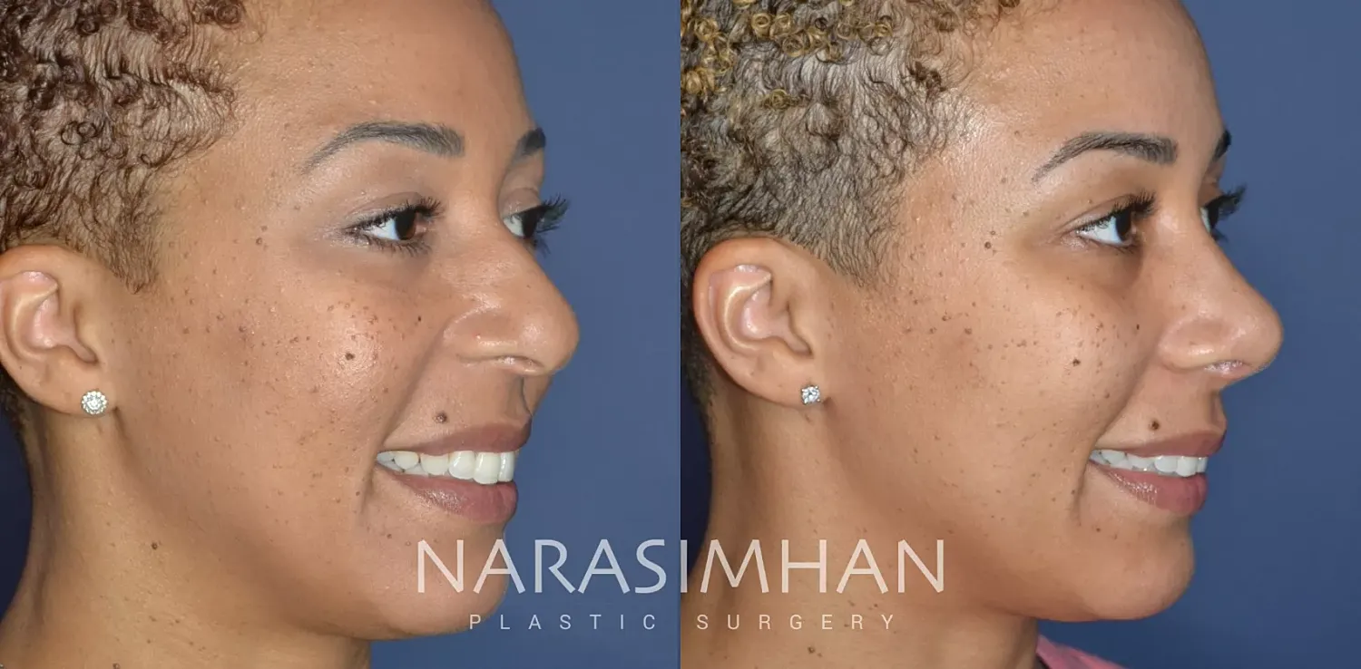 Facial Sculpting Before & After