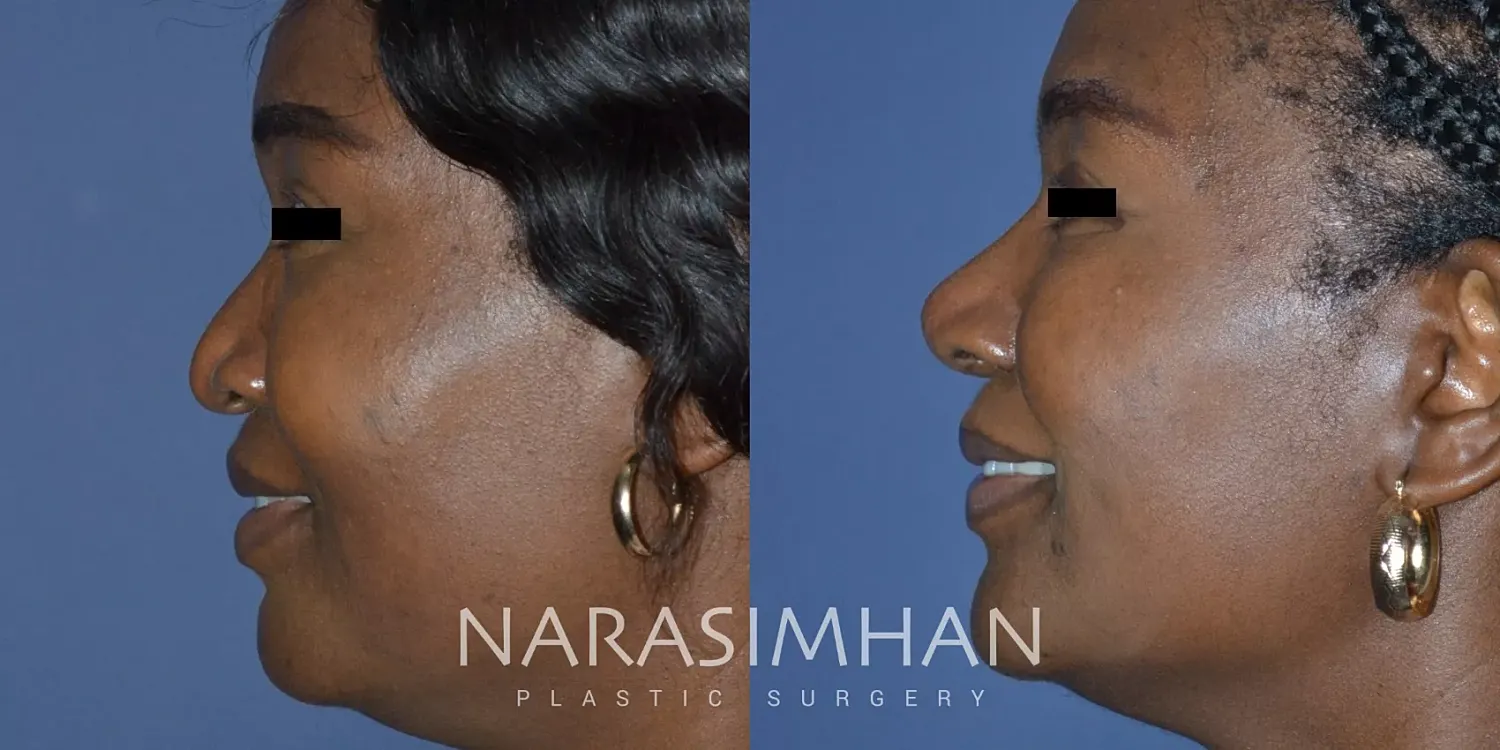 Facial Sculpting Before & After