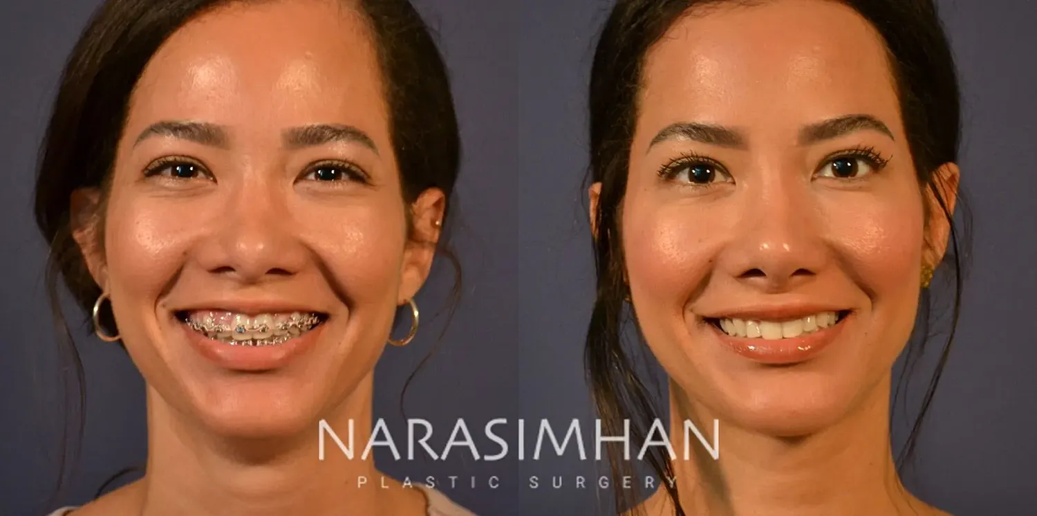 Facial Sculpting Before & After