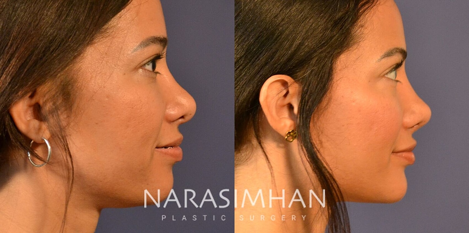 Facial Sculpting Before & After