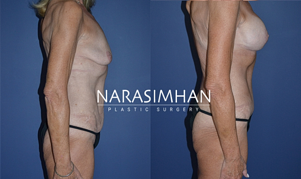 Breast Augmentation Before & After