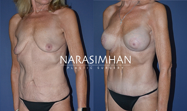 Breast Augmentation Before & After