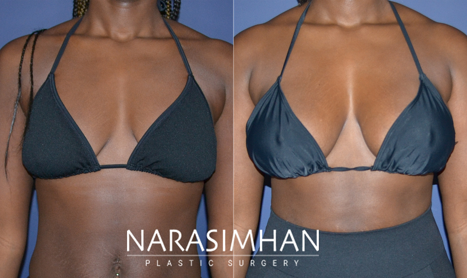 Breast Augmentation Before & After