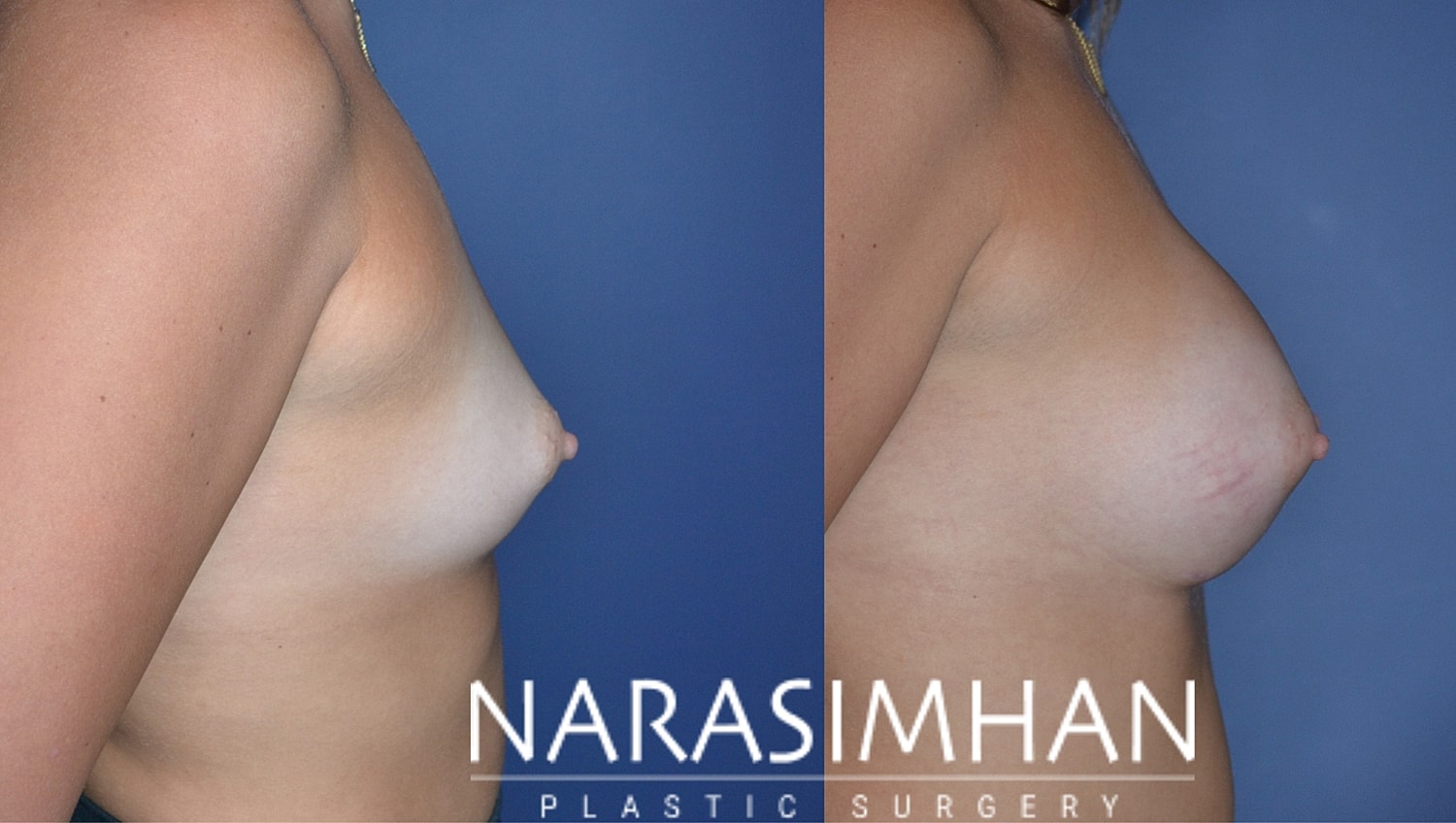 Breast Augmentation Before & After