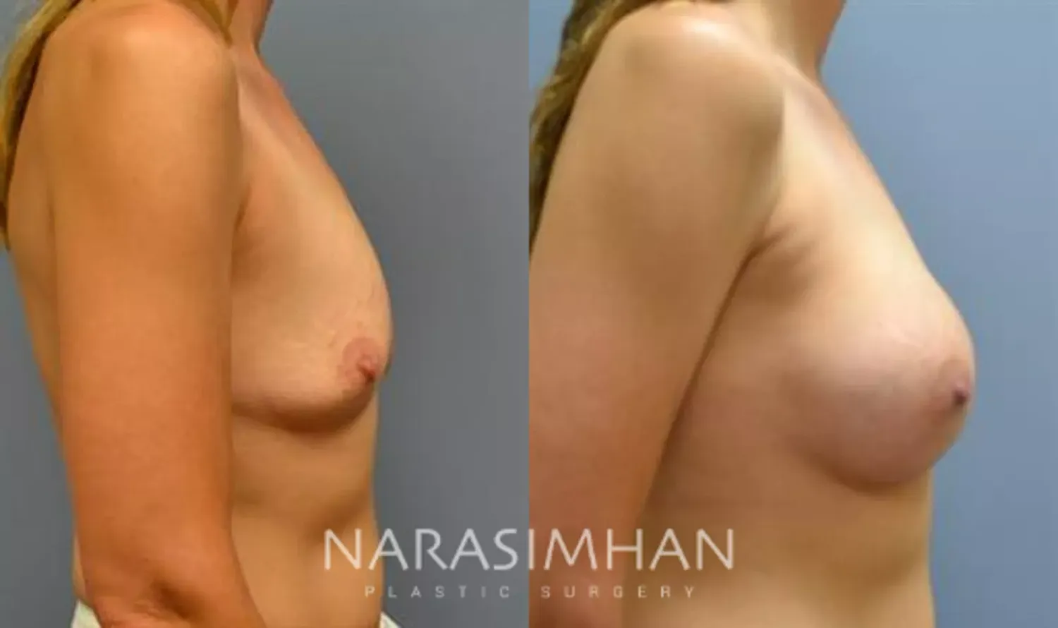 Breast Augmentation Before & After