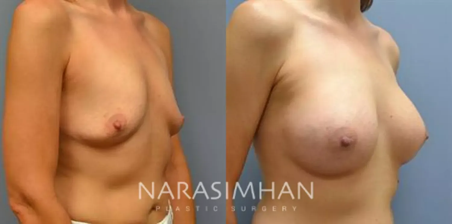 Breast Augmentation Before & After