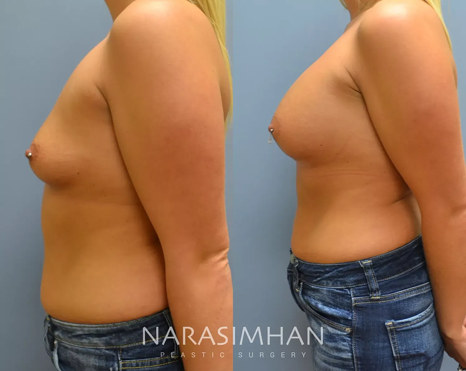 Breast Augmentation Before & After
