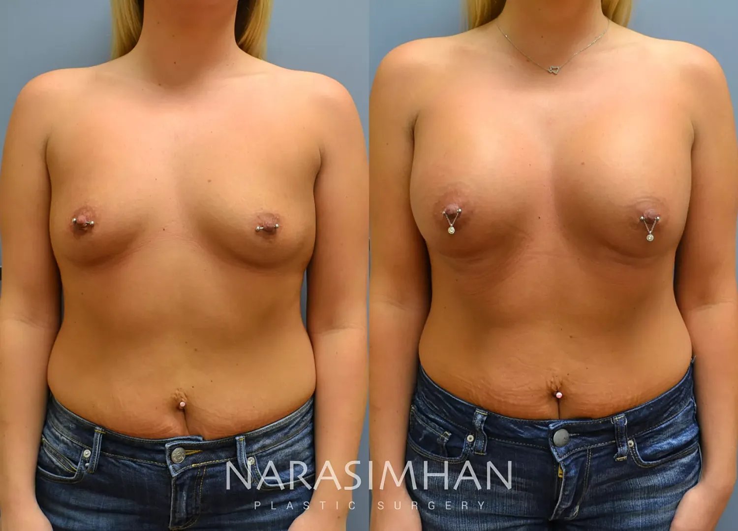 Breast Augmentation Before & After